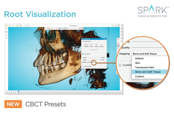 SPARK™ CLEAR ALIGNERS NEW RELEASE 12 GIVES DOCTORS MORE CONTROL, FLEXIBILITY AND EFFICIENCY IN CASE SETUP AND TREATMENT PLANNING